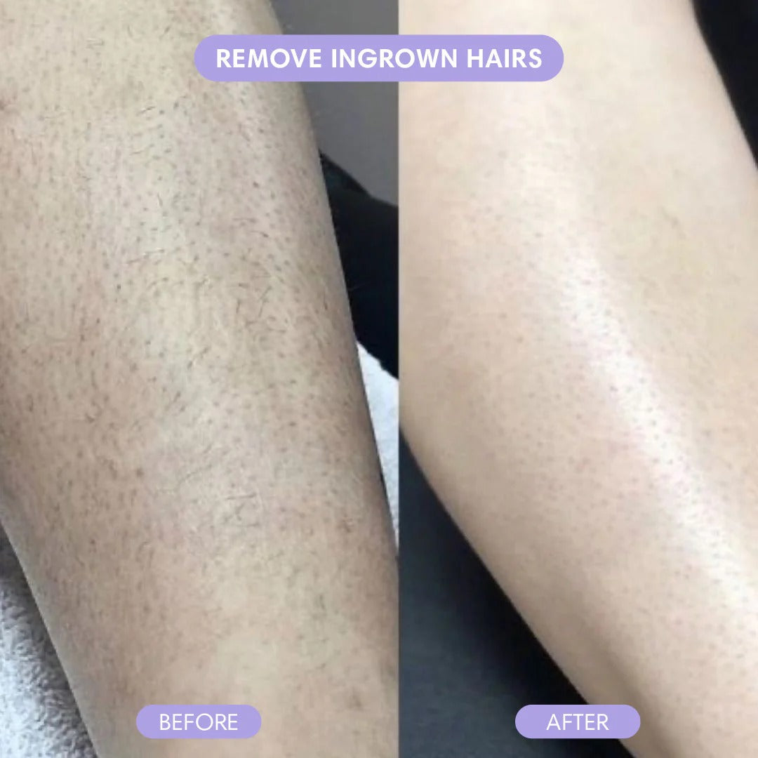 Barevia™ – Easy Hair Removal Mousse for Silky Skin