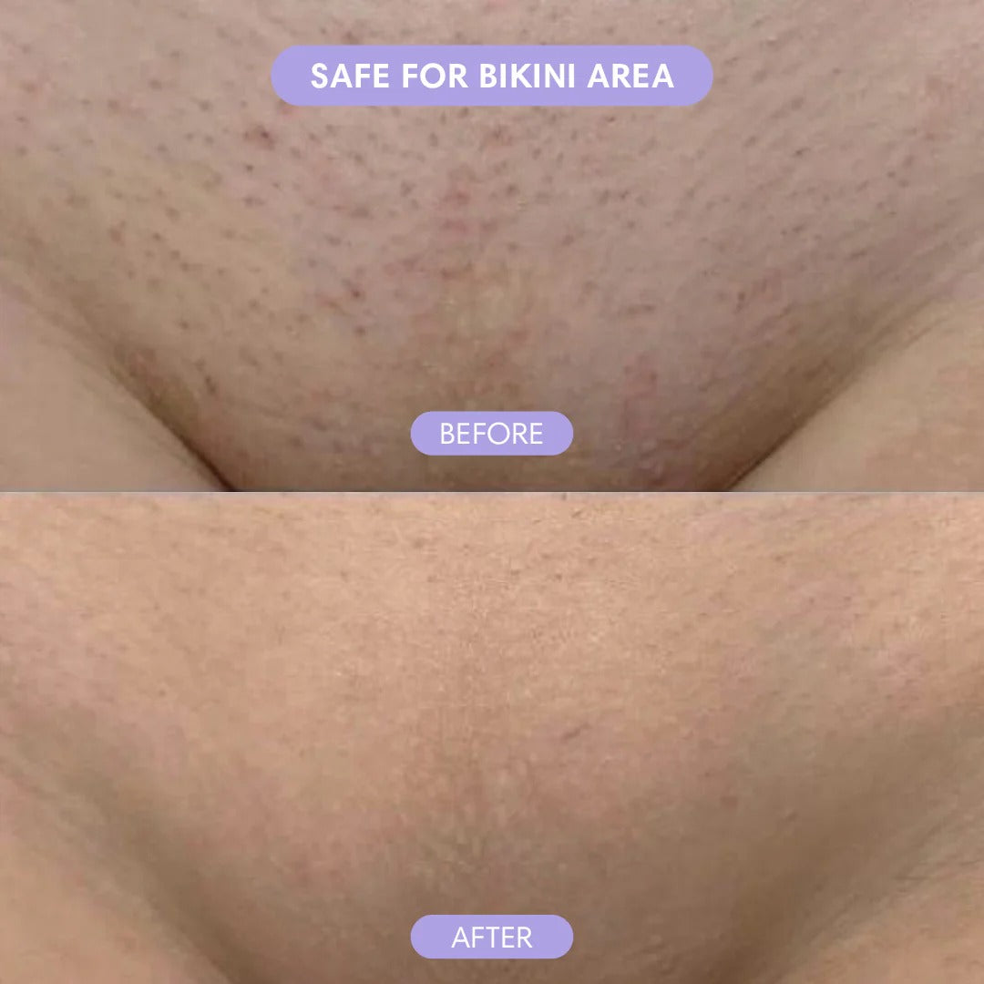 Barevia™ – Easy Hair Removal Mousse for Silky Skin