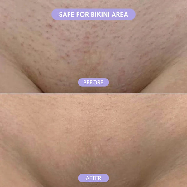 Barevia™ – Easy Hair Removal Mousse for Silky Skin
